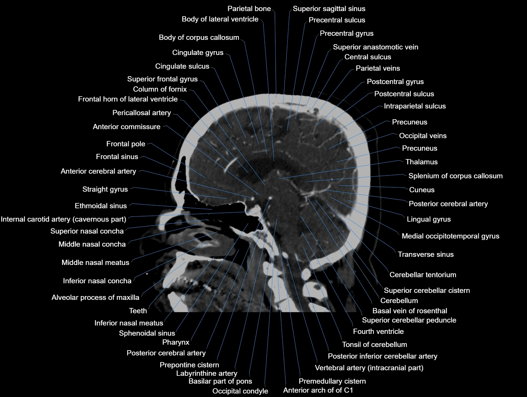 CT scan brain sagittal cross sectional anatomy image-img-00001-00037.webp